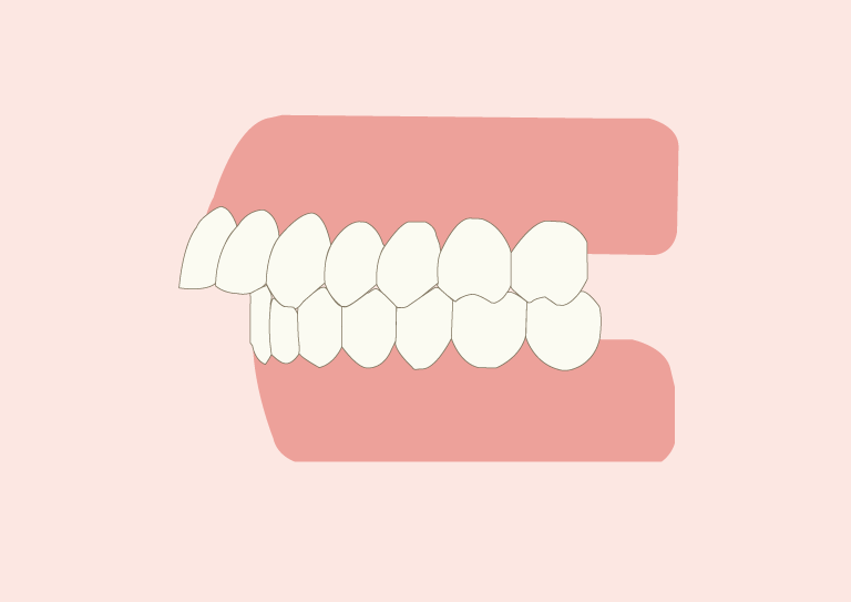 Invisalign and Fixing Overbites: How it Works, Timeline and More